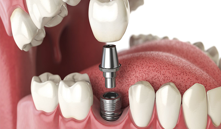 İmplant tedavisi ücretsiz mi olacak?